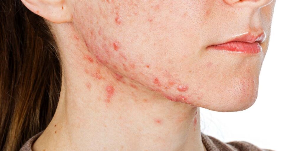 Understanding Acne: Causes, Types, Treatments, and Care Tips