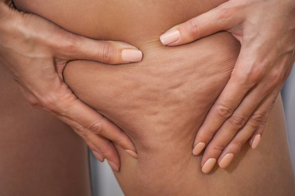 Unveiling the Truth About Cellulite Treatment Products