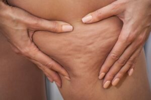 Unveiling the Truth About Cellulite Treatment Products