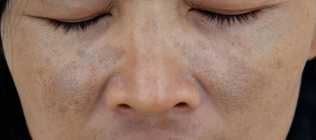 How to overcome Hyperpigmentation