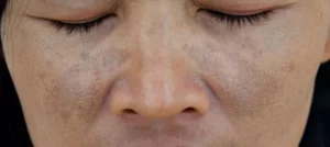 How to overcome Hyperpigmentation